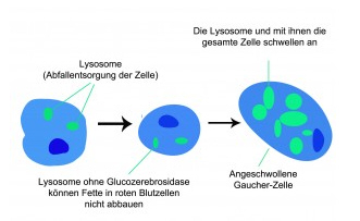 Morbus Gaucher Lyosome